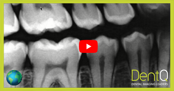 Come leggere le radiografie dentali?