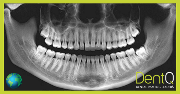 La scansione OPT (panoramica dentale)